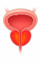 Entzündung der Prostata.