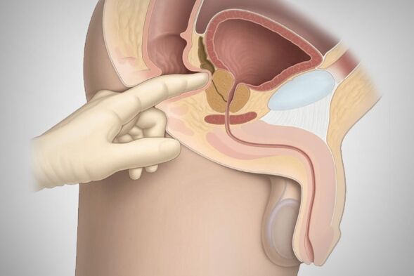 Prostatamassage bei bakterieller Prostatitis.